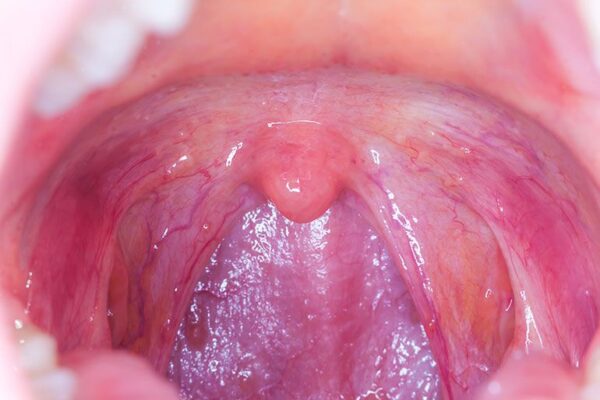 Oral sex cancer: What you need to know