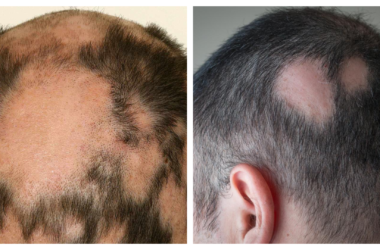 Alopecia areata: Health condition that currently has no cure