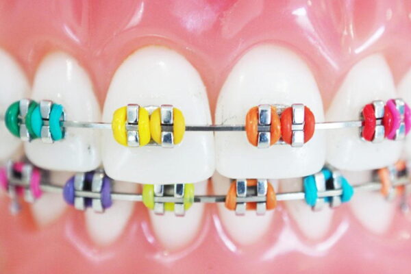 Top 10 braces colours: Check out several funky colours to style your braces